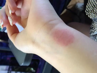 貼完出來很多小紅疙瘩，還特別癢，怎么回事？是過敏嗎？